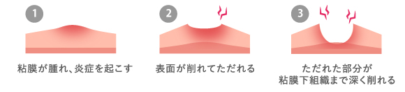 口内炎ができるまでの流れ