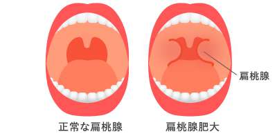 扁桃炎の図
