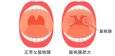 扁桃炎の図