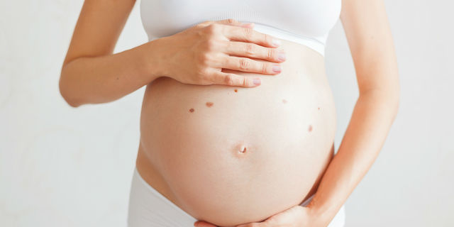 妊娠してほくろが増えた妊婦
