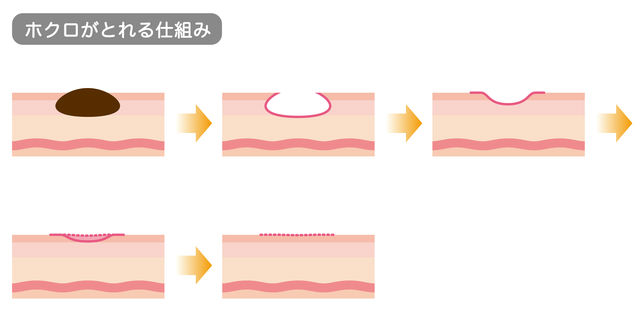 ほくろをレーザー治療で除去
