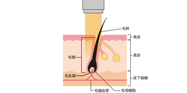 レーザー脱毛