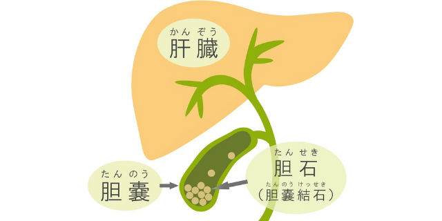 胆石症