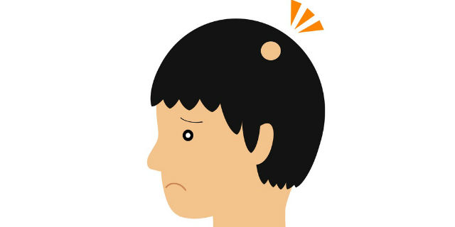 円形脱毛症