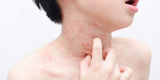 子どもの皮膚の病気