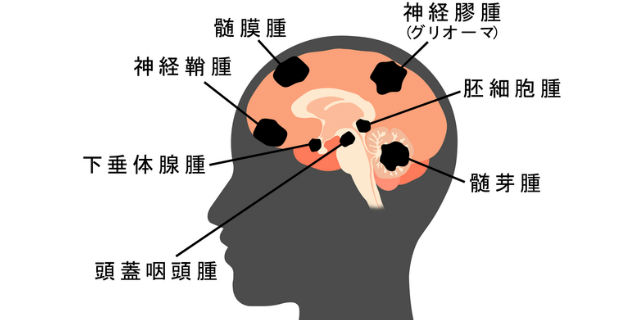 脳腫瘍