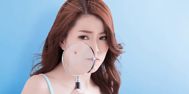 ストレスや疲れでニキビが…大人ニキビの正しいケア方法を医師が解説