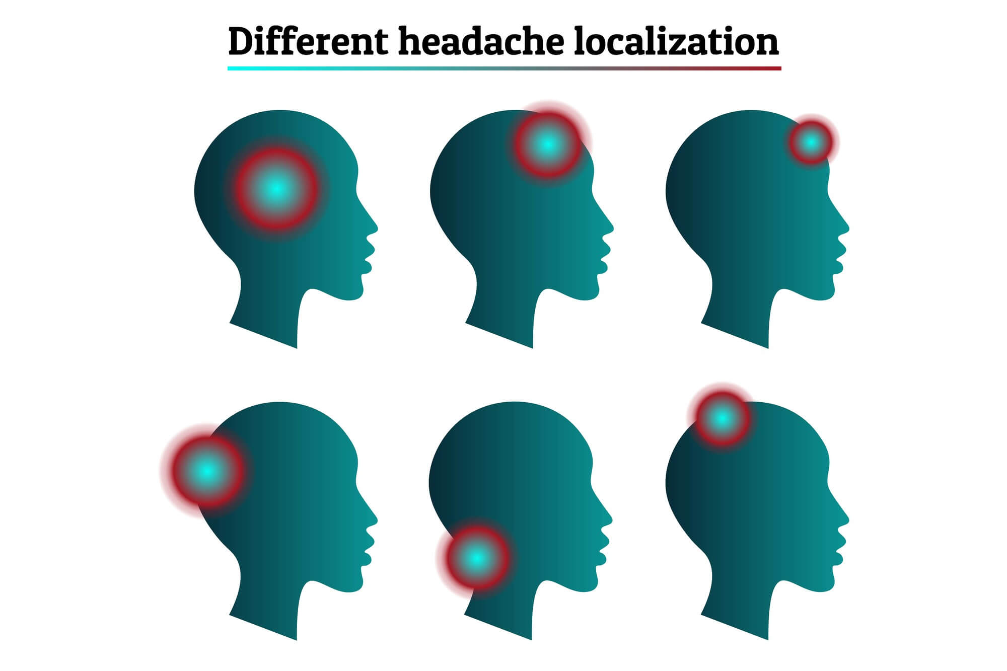 頭痛の種類