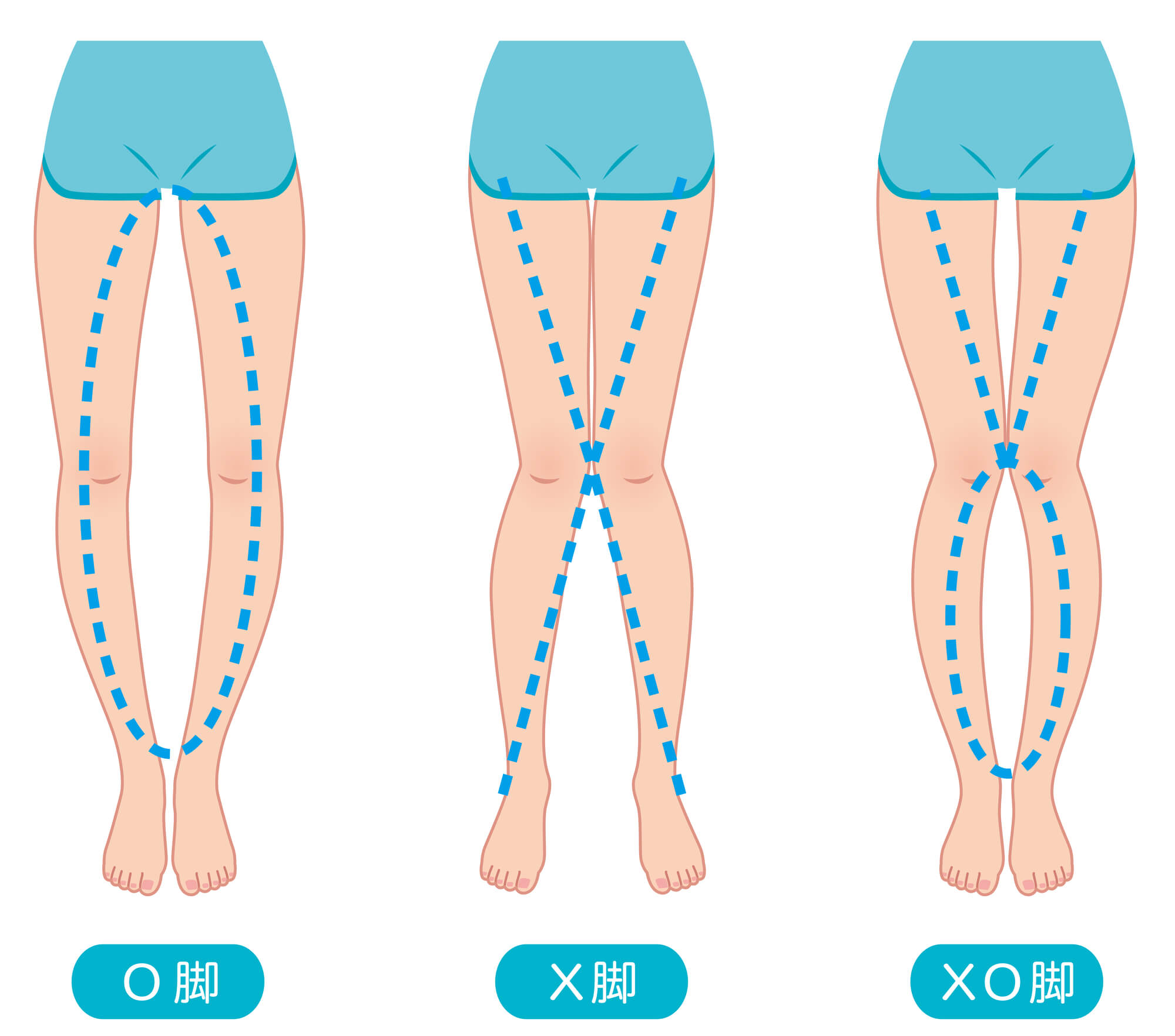 X脚とO脚の症状